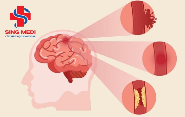 10 dấu hiệu tai biến ai cũng cần biết để xử lý kịp thời