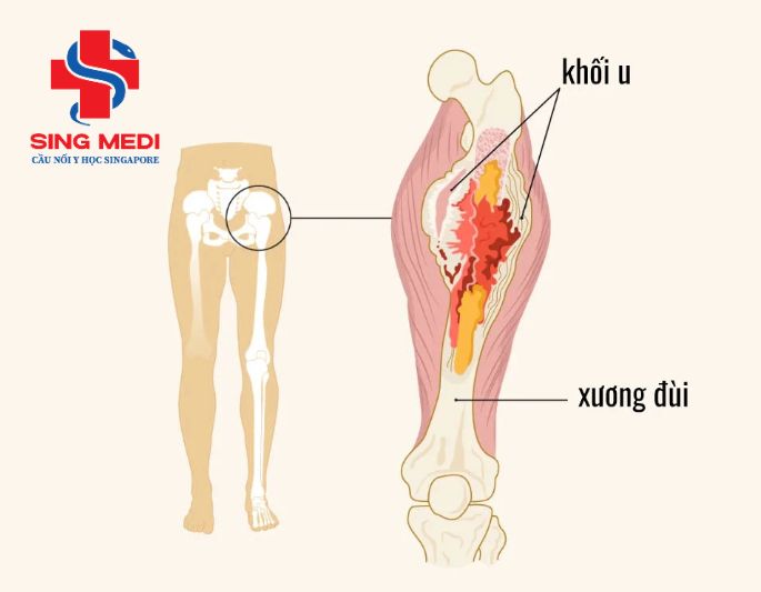 Kiến thức cơ bản về ung thư xương
