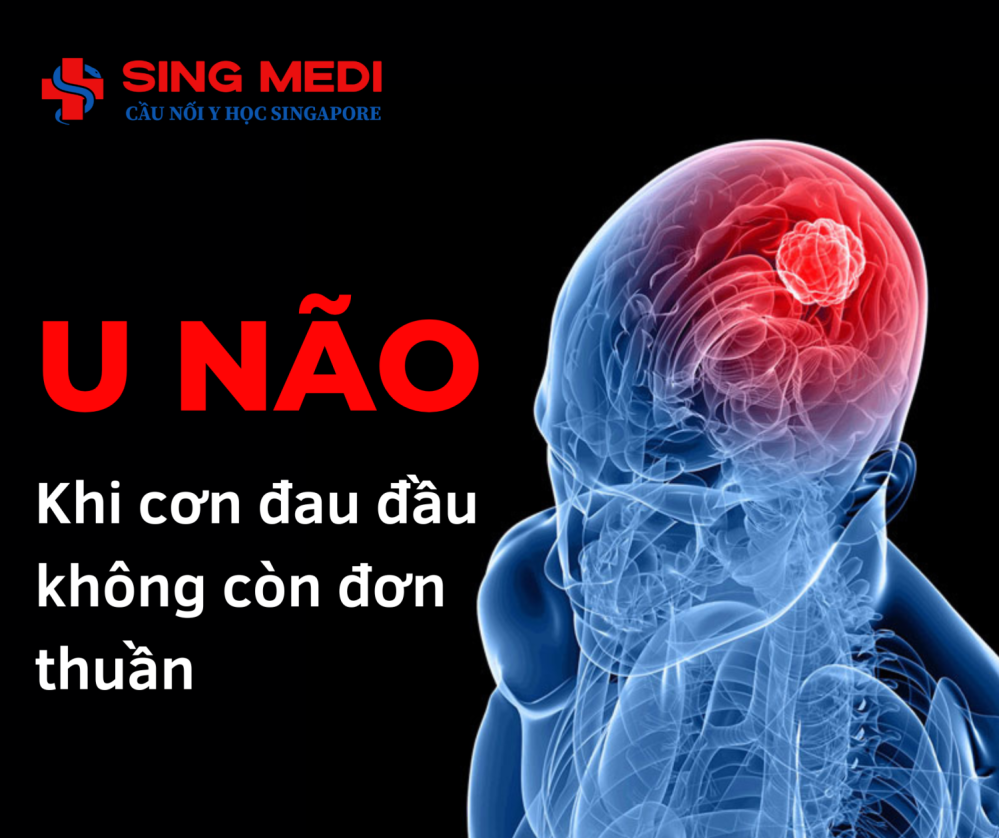 U não: Khi cơn đau đầu không còn đơn thuần