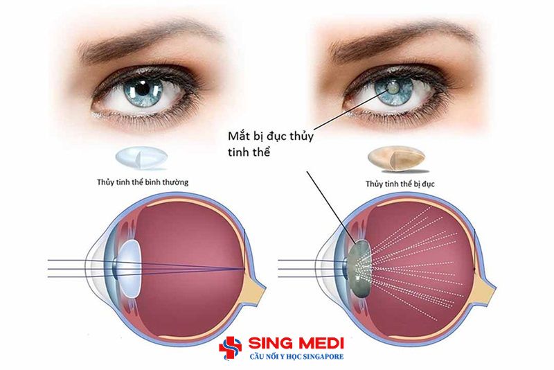 Đục thủy tinh thể: Nên mổ sớm, đừng chần chừ