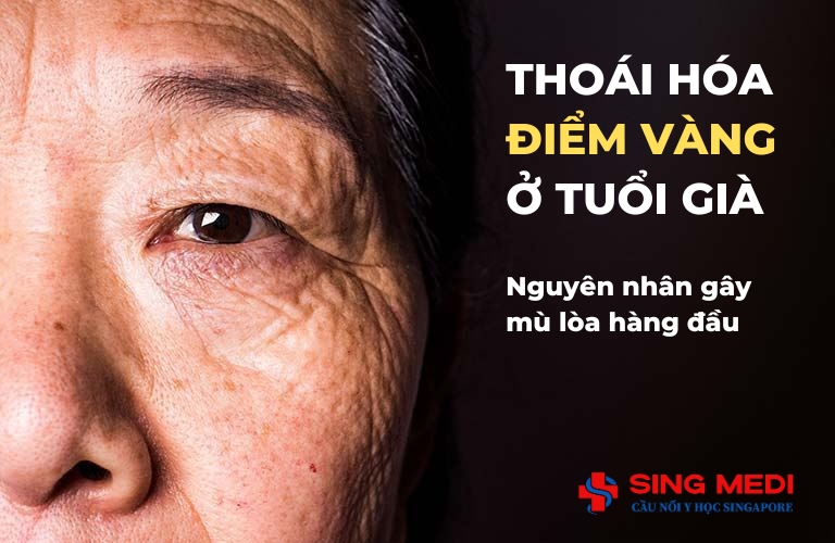 Bệnh lý thoái hóa điểm vàng tuổi già (AMD): Nguyên nhân hàng đầu gây mù lòa – và vì sao nên điều trị tại Singapore?
