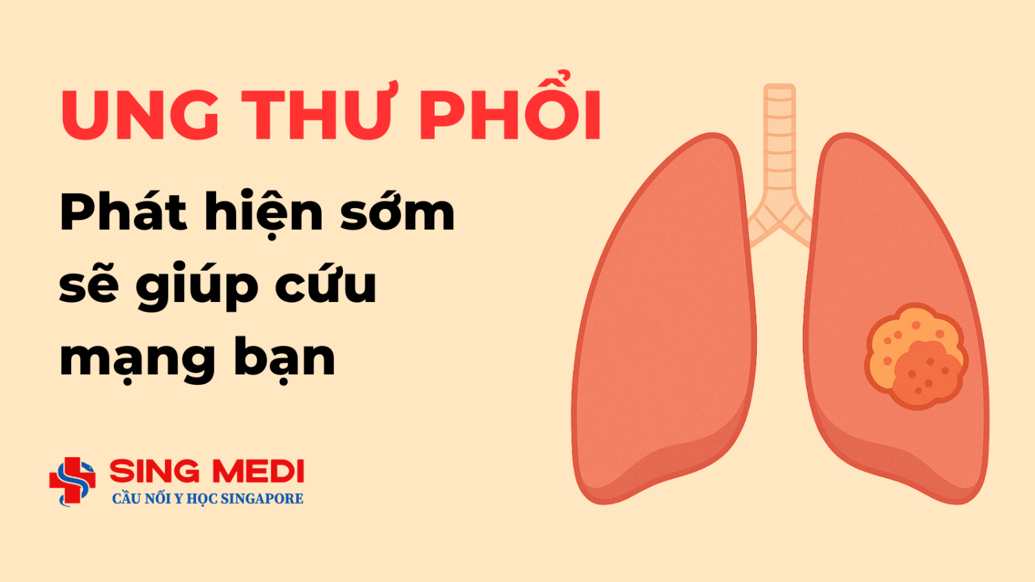 Ung thư phổi - Phát hiện sớm sẽ giúp cứu mạng bạn